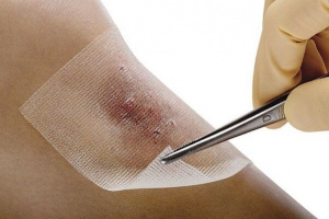زخم پای دیابتی چگونه درمان می شود؟