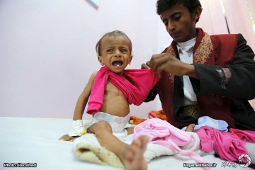 سوءتغذیه در کودکان یمنی